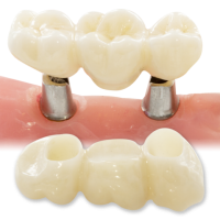 ZCeram FC implant bridge